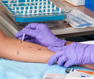 Skin prick allergy test